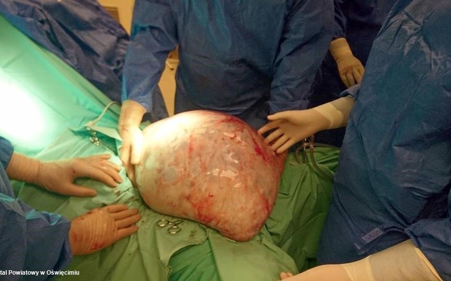 Lekarze wycięli młodej pacjentce około 30-kilogramowego guza – FILM, FOTO