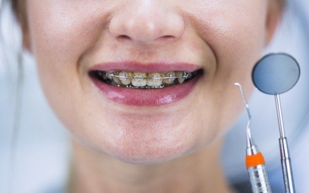 Aparat ortodontyczny – jaką dietę powinniśmy stosować?