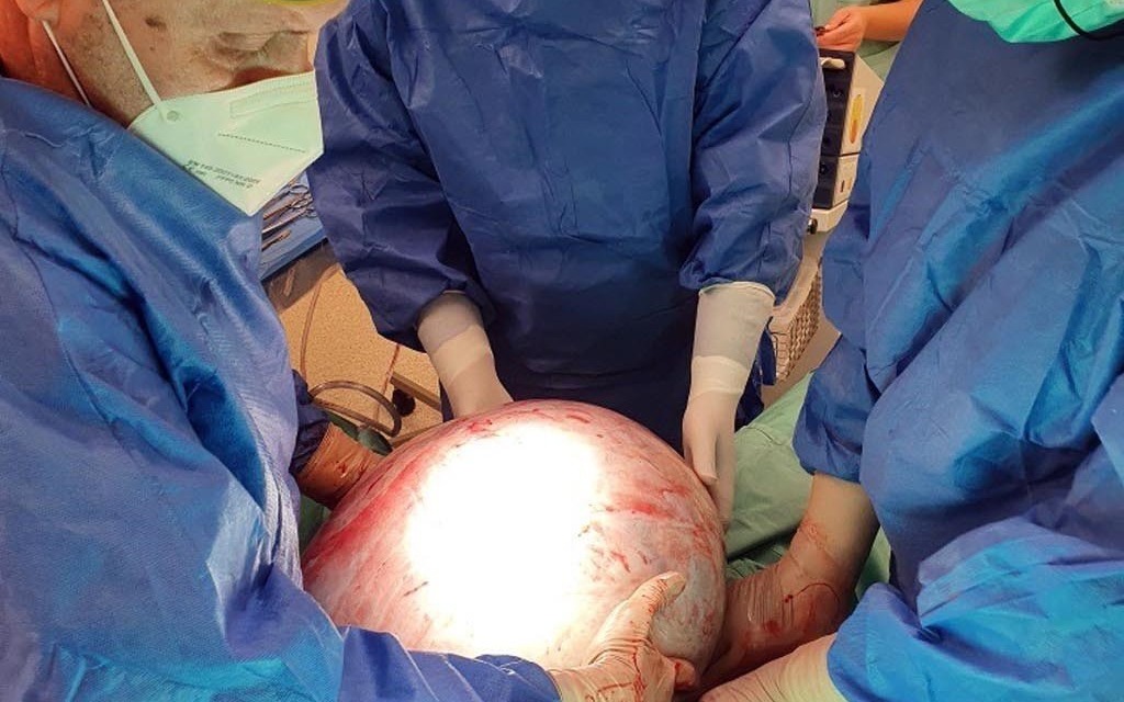 30 kilogramowy guz usunięty przez personel Szpitala Powiatowego w Oświęcimiu