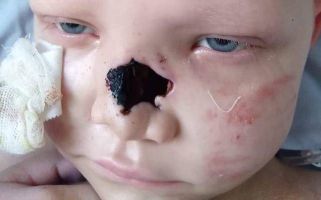 Klaudia Witak już po przeszczepie, teraz potrzebuje nowego nosa