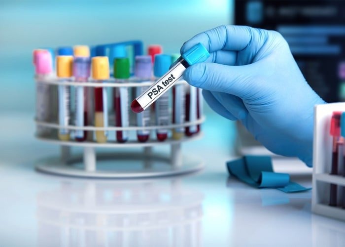 Darmowy test "PSA" dla mężczyzn powyżej 40. roku życia - InfoBrzeszcze.pl
